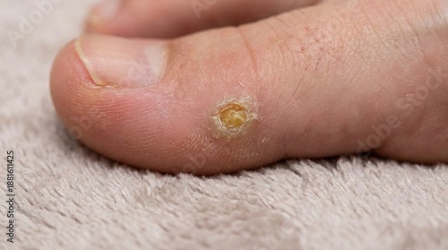 Close up of a painful corn on a human toe