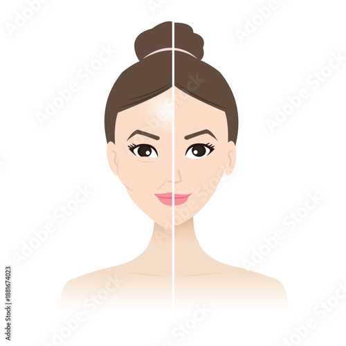 Comparison of facial overfilled syndrome and normal skin on woman face vector illustration. When too much filler is injected into the face it makes the face look unnatural. Medical and beauty concept.
