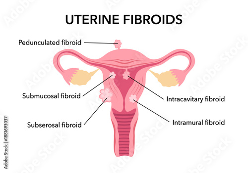 Flat vector illustration of uterine fibroids, myoma, uterine leiomyomas on dark blue background. There are cervical canal, cervix, vagina, pedunculated, intracavitary, submucosal, subserosal fibroid.