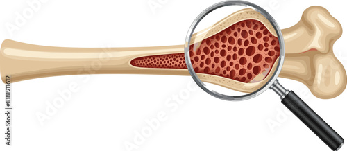 Human Bone Anatomy with Magnified Osteoporosis Structure Vector Illustration Isolated on White Background for Medical and Healthcare Education