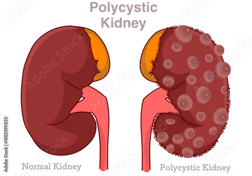 Polycystic kidney disease. PKD, PCKD or polycystic kidney syndrome is a genetic disorder that causes many fluid filled cysts to grow in kidneys. Urinary system. Illustration vector