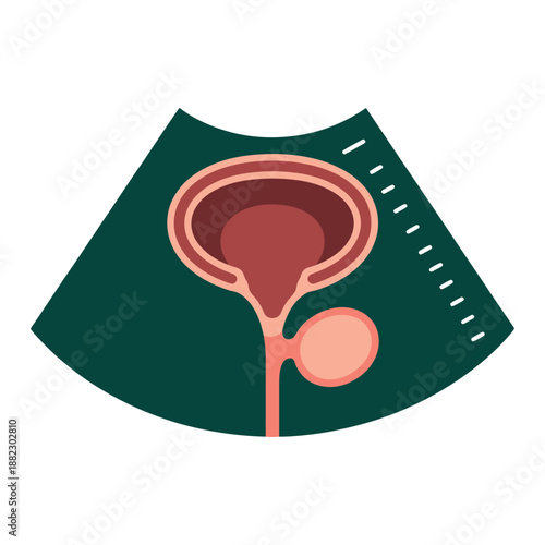 Anatomical illustration of the female reproductive system showing the uterus and ovary