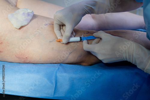 Slika na platnu Leg vein injections reduce visibility of varicose and spider veins and improve appearance