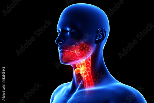 Throat cancer tumor Human neck anatomy with inflamed lymph nodes and throat image