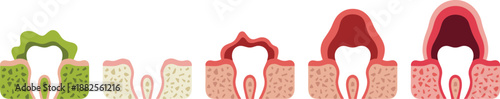 Anatomical Diagram Showing Stages of Gum Disease and Tooth Extraction, Including Healthy Gums, Recession, Inflammation, Bone Loss, and Missing Tooth Space