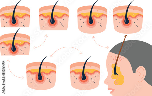 Anatomy of hair follicle growth cycle and sebaceous gland inflammation causing acne on human face skin layers medical health illustration
