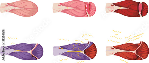 Anatomy of Human Muscle Tissue Showing Stages of Neurological Activation Tension Strain and Inflammation for Medical Science Education and Healthcare Design
