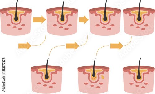 Medical anatomy illustration showing hair follicle growth cycle laser hair removal process and skin inflammation with sebaceous gland acne formation