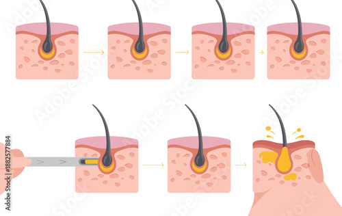 Medical illustration of laser hair removal process on skin follicle showing permanent reduction and temporary inflammatory response for dermatology aesthetic treatments