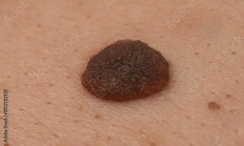 Foto Raised mole close up on human skin with detailed nevus texture