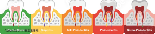 Stages of gum disease and periodontal progression diagram showing healthy gums gingivitis mild periodontitis and severe tooth decay in gums