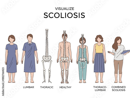 Visual representation of scoliosis and its effects on the human body