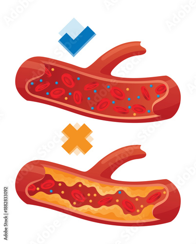 Types of cholesterol in human blood vessels. Normal and narrowed artery for explanation diseases. High-Density Lipoprotein HDL and Low-Density Lipoprotein LDL. Vector illustration