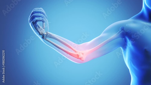 X-ray image of a blue human elbow with painful spots highlighted in red.