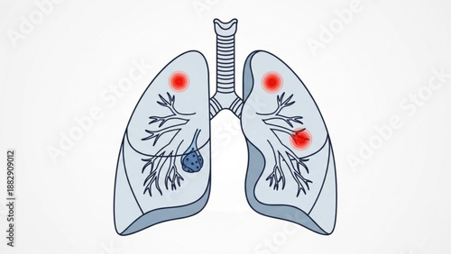 Human lungs with bronchial tree and red tumor nodules medical illustration for healthcare and educational purposes