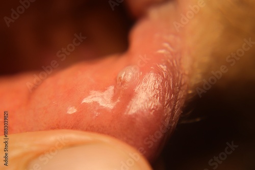 Close-up lip connective tissue formed by excessive wound healing. Medical concept showing oral fibrosis and scar tissue, for dentistry, pathology, oral surgery, healthcare