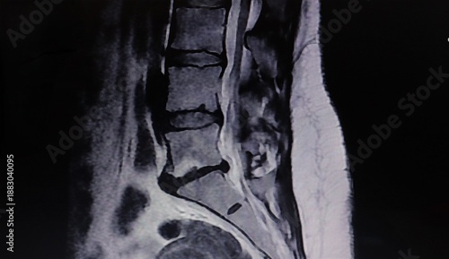 Axial CT scan showing bipolar disc herniation with anterior and posterior extension in the lumbar sacral spine, ideal for medical education, radiology reference, diagnosis, and healthcare content.