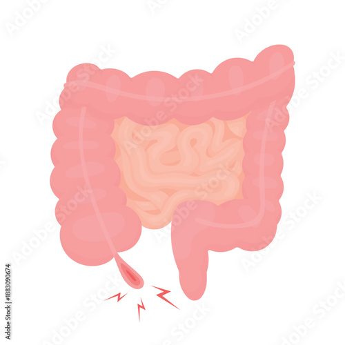 Vector illustration of intestines with inflamed appendix. Medical concept of appendicitis, abdominal pain, digestive system health, emergency condition, healthcare education, isolated on white backgro
