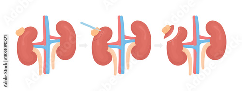 Vector illustration showing kidney tumor removal in three stages. Medical concept of renal surgery, neoplasm treatment, urology procedure, healthcare, anatomy infographic, isolated on white background