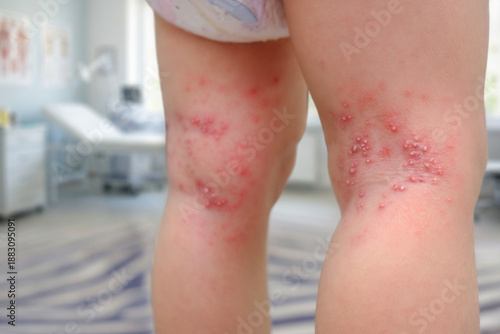 A close-up view of a child’s legs showing a visible skin rash with red inflamed areas and small bumps concentrated around the knees and skin folds in a medical examination setting. The image clearly i
