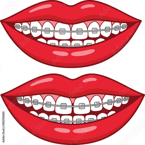 Flat vector illustration, cartoon mouths with braces, dental care concept, orthodontic treatment, smiling teeth, oral health, medical sketch