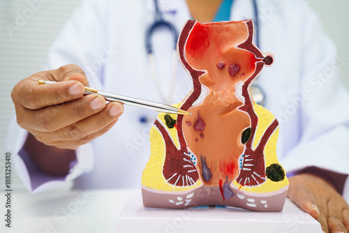 Fotografi Asian doctor with rectum and hemorrhoid human anatomy model at hospital, inflamed vascular structure