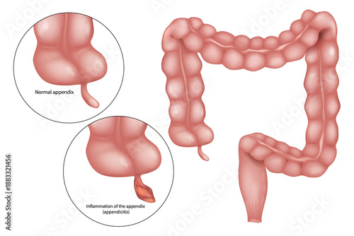 Appendicitis Medical Illustration of Human Colon. Human Large Intestine Anatomy with Normal and Inflamed Appendix Diagram