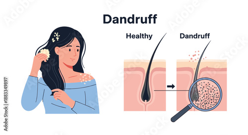 Medical illustration about dandruff showing a woman with flakes on her hair and a microscopic view of a scalp and hair follicle.