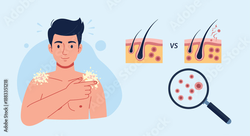 Man pointing to dandruff on his shoulders accompanied by skin cross sections and microscopic view of flakes and germs.