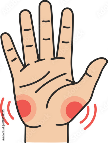 Medical vector illustration of an open human palm featuring red circular zones and radiating lines to indicate localized pain, inflammation, swelling, or symptoms of carpal tunnel syndrome and arthrit