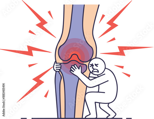 Medical vector illustration depicting severe knee pain, featuring a giant inflamed joint with radiating red lightning bolts and a small, distressed character clutching the leg to symbolize agony, arth