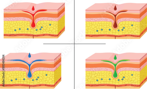 Cross section of human skin showing tattoo ink penetration in epidermis and dermis layers with four different colors for medical education.