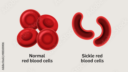 Comparison of Normal and Sickle Red Blood Cells Illustration