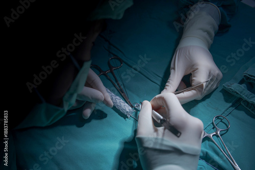 Photos Surgeon preparing Physician Modified Endovascular Graft (PMEG) using an aortic stent graft in operating room