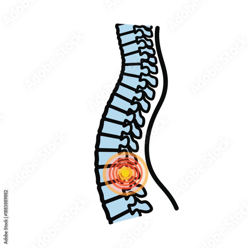 A cartoon drawing of a spine with a painful section