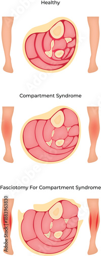 Compartment Syndrome Pathology Symptoms and Fasciotomy Treatment