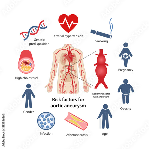 Abdominal aortic aneurysm. Risk factors for aortic aneurysm development. Flat style medical vector illustration isolated on a white background.
