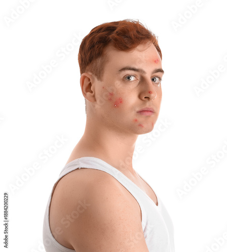 Teenage boy with acne on wh...