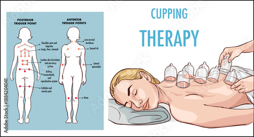 Medical cupping therapy on the back stock vector  illustration