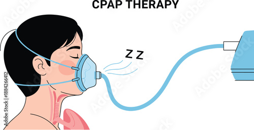 CPAP therapy sleep apnea treatment illustration, patient using breathing mask machine, medical respiratory care concept, isolated white background, flat vector illustration