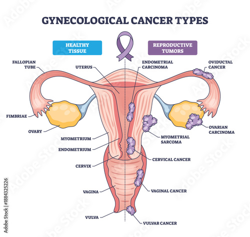 Vaginal vs cervical vs uterine cancer illustrated to compare tumor locations across the female reproductive system, key structures, uterus, cervix, vagina. Outline diagram