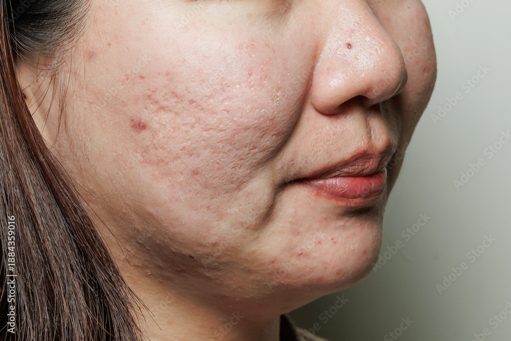 Obraz premium Real young woman's face with acne scars, blemishes and oily skin texture, dermatology and skincare concept.