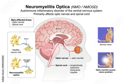 Neuromyelitis Optica - NMO - NMOSD Eye Flashcard
