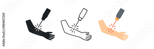 laser dermatology laser beam removing tiny cherry angioma on