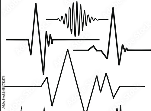 Black and white electrocardiogram printout with irregular heartbeat patterns waveform
