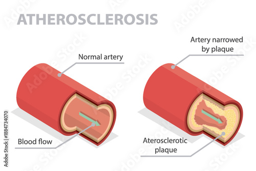 Difference between a normal artery and one affected by atherosclerosis. Labeled isometric educational medical flat banner.