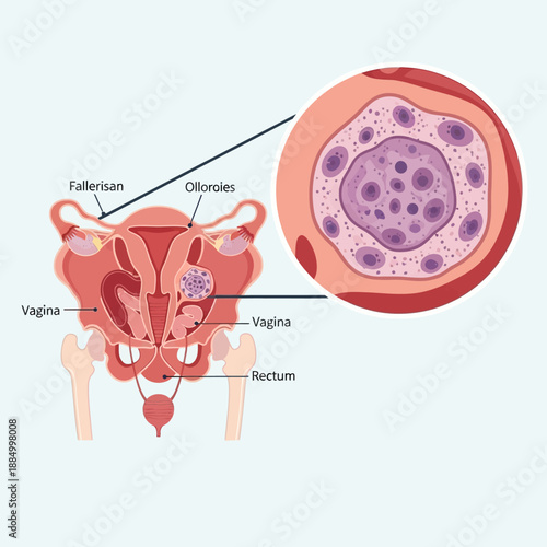 Female Reproductive System Anatomy Diagram with Ovarian Cysts