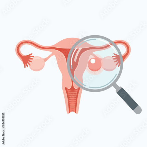 Uterus and ovaries with a cyst under a magnifying glass, medical illustration