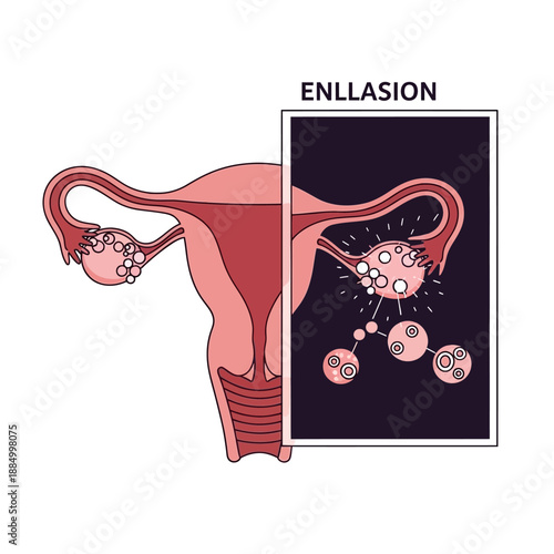 Ovarian Cyst Illustration: Uterus and Enlarged Ovary with Cysts