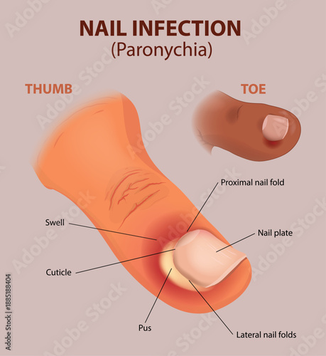 Nail Fold Infection Anatomy Illustration diagram